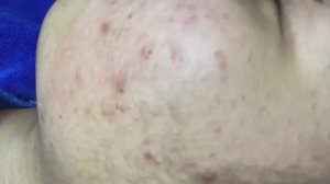 049 • Acne collection • АСМР • Relax Spa