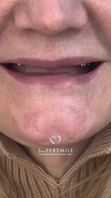 До и после. Имплантация зубов