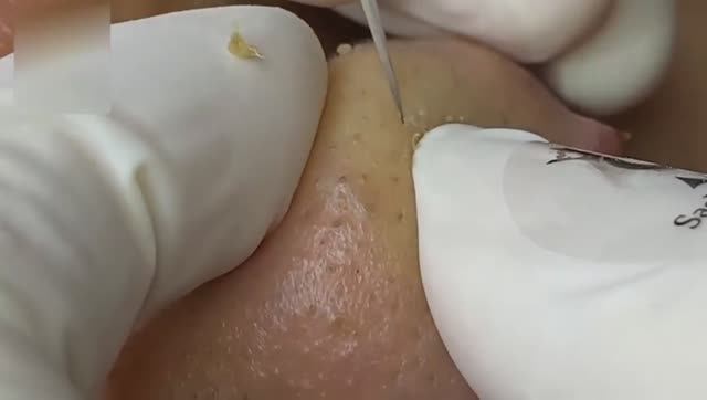 Избавляемся от угрей на лице. Удаление