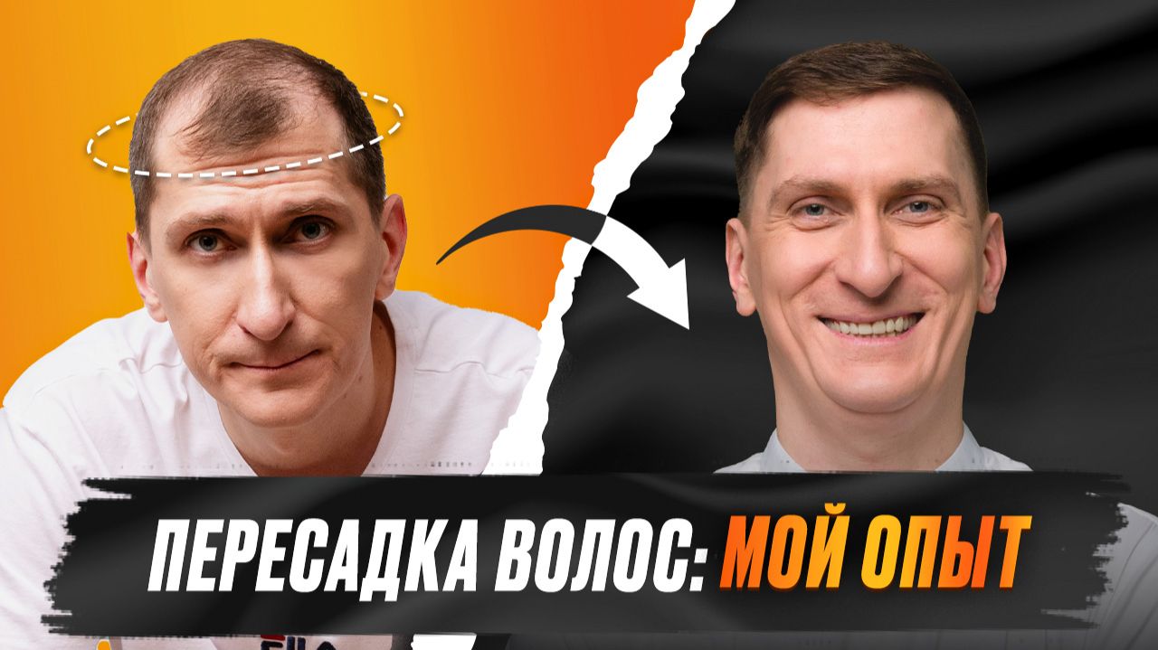 👴 Пересадка волос: мой опыт. Как выбрать клинику, что ждать после операции и когда нужна коррекция