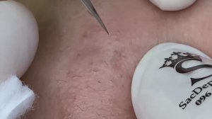 Asmr. Механическое очищение от акне