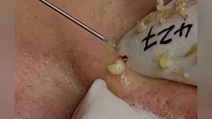 Выдавливание прыщей, угрей, черных точек и камедонов #322