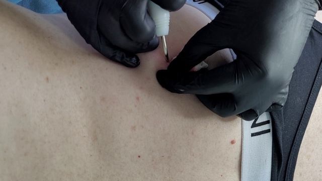 Удаление невусов на коже спины