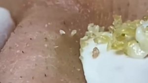 #224 Чистка лица от угрей и акне. Выдавливание прыщей. Удаление черных точек и комедонов