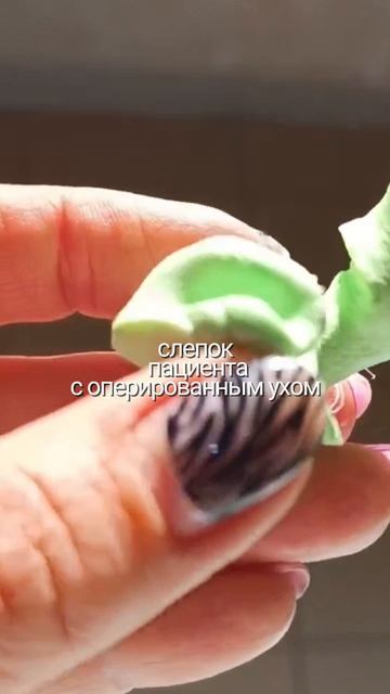 Слепок оперированного уха.