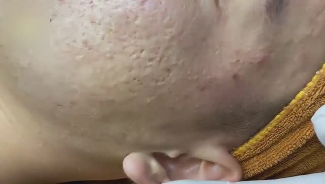 Глубокое очищение пор от прыщей