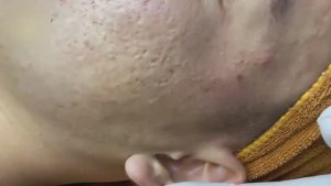 Глубокое очищение пор от прыщей