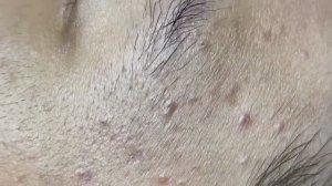 050 • Acne collection • АСМР • Relax Spa