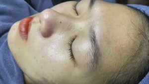 Избавляемся от прыщей и черных точек вместе. Одна процедура.