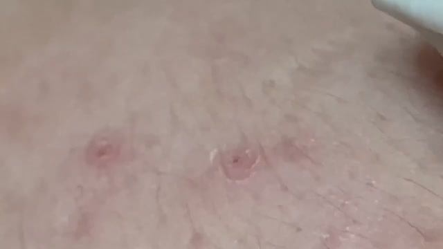 Механическая чистка лица: удаление комедонов и акне