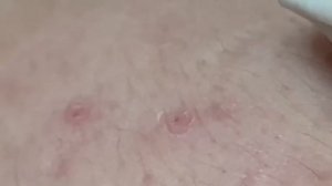 Механическая чистка лица: удаление комедонов и акне