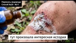 25 приёмов с перекисью водорода.