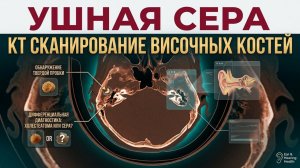 СЕРНАЯ ПРОБКА в ухе, снижение слуха и ШУМ В ЛЕВОМ УХЕ на расшифровке КТ височных костей