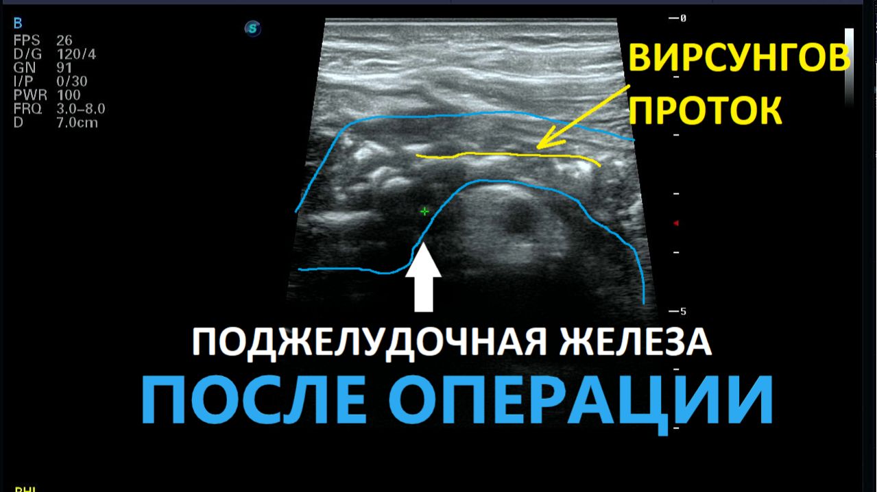 Поджелудочная железа на УЗИ после большой операции