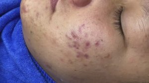 Удаление угрей. Профессиональное очищение кожи