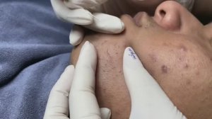 Asmr. Чистим лицо от прыщей.