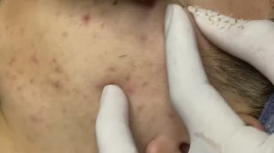 Удаление прыщей по шагам