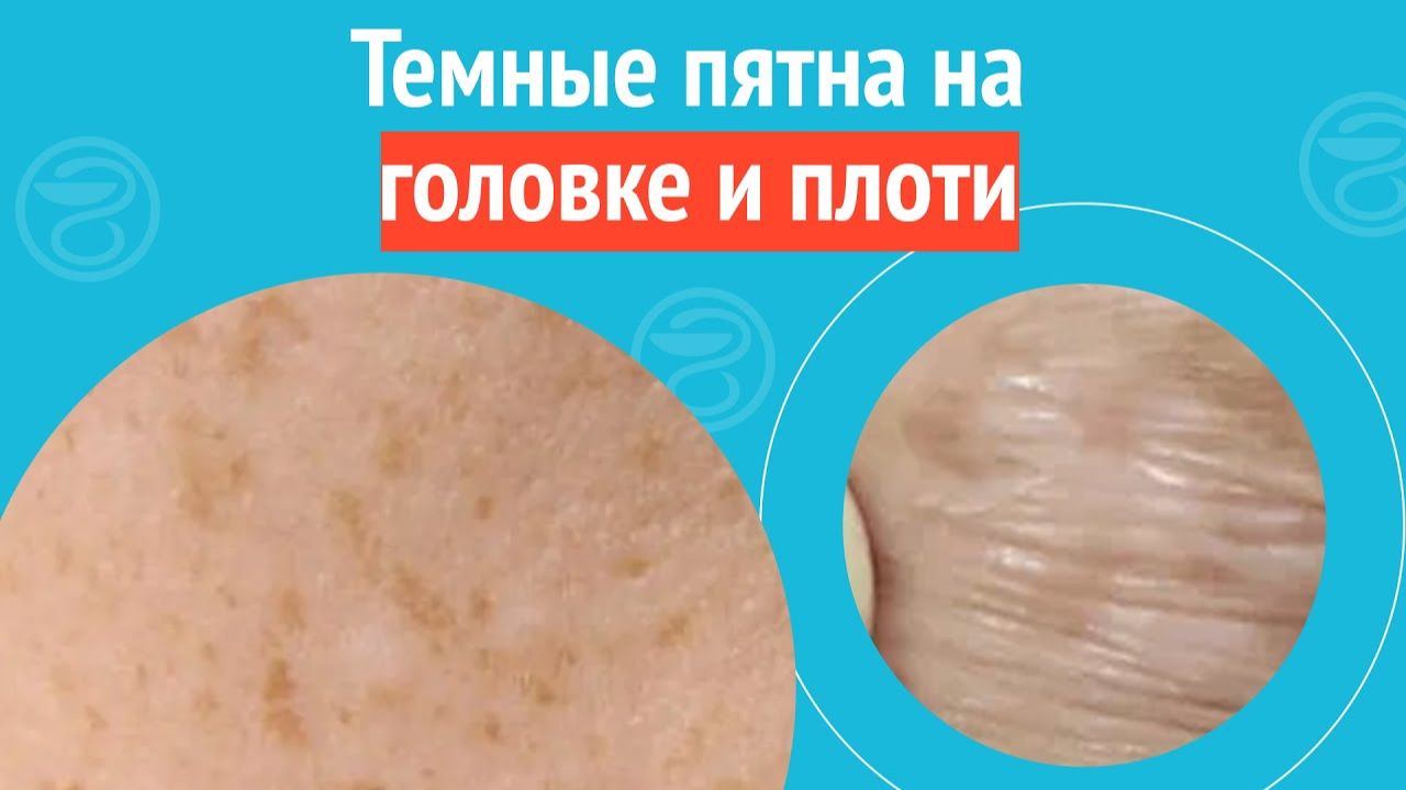 👉 Темные пятна на головке и плоти. Клинический случай №1300 смотреть онлайн