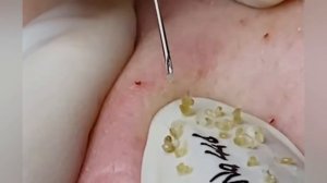 Выдавливание прыщей, угрей, черных точек и камедонов #325