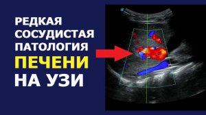 Врожденная сосудистая мальформация печени. Редкая патология на УЗИ