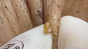 #226 Чистка лица от угрей и акне. Выдавливание прыщей. Удаление черных точек и комедонов