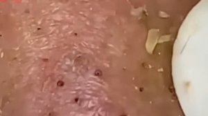 #227 Чистка лица от угрей и акне. Выдавливание прыщей. Удаление черных точек и комедонов