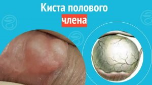 👉 Киста полового члена. Клинический случай №1304