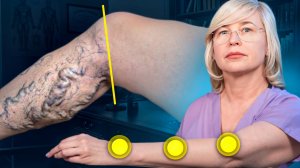 4 ТОЧКИ И РУЛЕТКА ОТ ВСПУХШИХ ВЕН И УЗЕЛКОВ В ЩИТОВИДКЕ