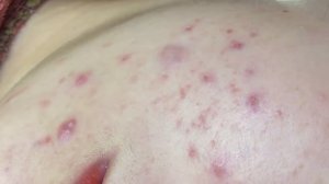 Профессиональное избавление от угревой сыпи