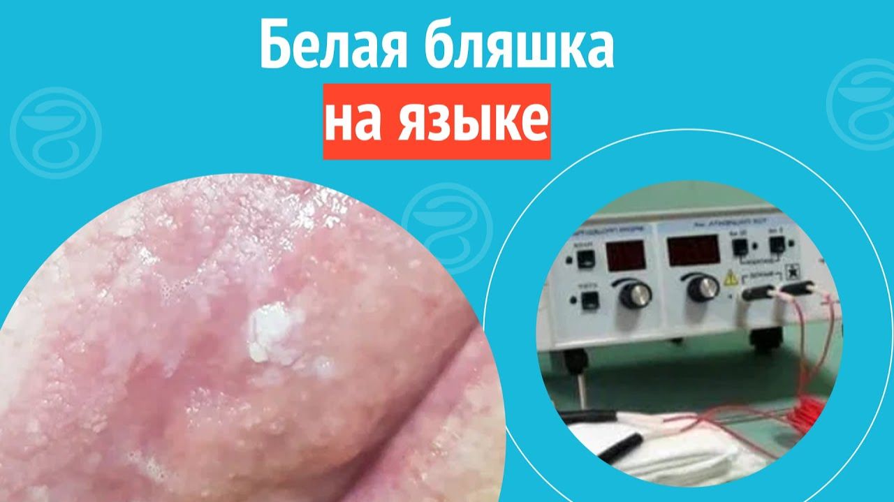 👅 Белая бляшка на языке. Клинический случай №1303 смотреть онлайн