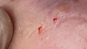 Выдавливание прыщей, угрей, черных точек и камедонов #327