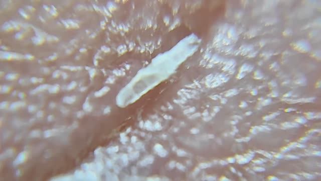 Удаление рыбной косточки из пальца