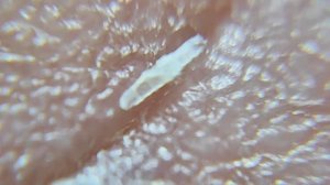 Удаление рыбной косточки из пальца