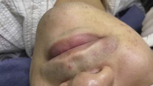 054 • Acne collection • АСМР • Relax Spa