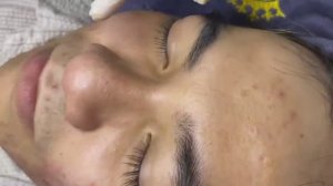 056 • Acne collection • АСМР • Relax Spa