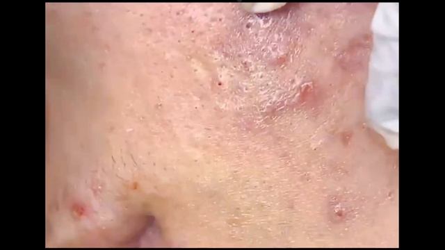 Удаление милиумов и закрытых комедонов