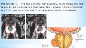 САМЫЙ ПОЗНАВАТЕЛЬНЫЙ КАНАЛ. ВСЁ О РАКЕ ПРОСТАТЫ.
