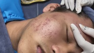 Чистка лица: превращение из гадкого утенка