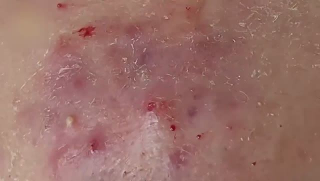 Asmr. Механическая чистка кожи от акне