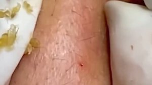 #230 Чистка лица от угрей и акне. Выдавливание прыщей. Удаление черных точек и комедонов