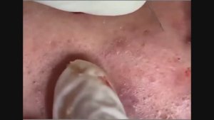 Чистка лица на сложном клиенте