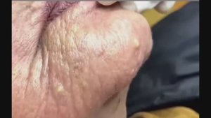 Глубокая чистка лица с удалением сальных пробок