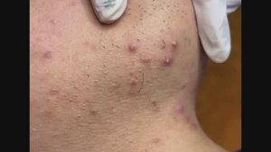 Уничтожение черных точек и акне 💣