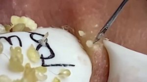 #229 Чистка лица от угрей и акне. Выдавливание прыщей. Удаление черных точек и комедонов