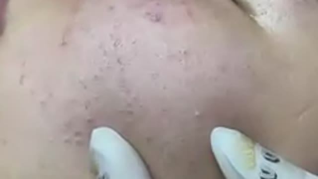 Удаление милиумов и закрытых комедонов