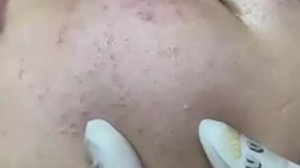 Удаление милиумов и закрытых комедонов