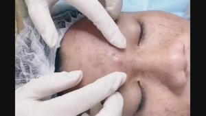 Убийца комедонов: жесткая чистка