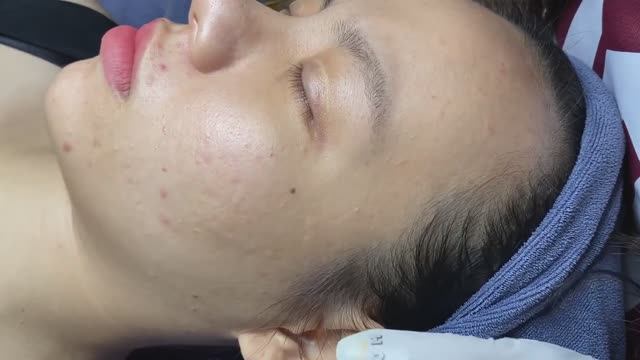 Профессиональное удаление угрей и черных точек