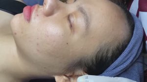 Профессиональное удаление угрей и черных точек