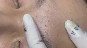 Чистка лица от прыщей как игра: убрать все до одного